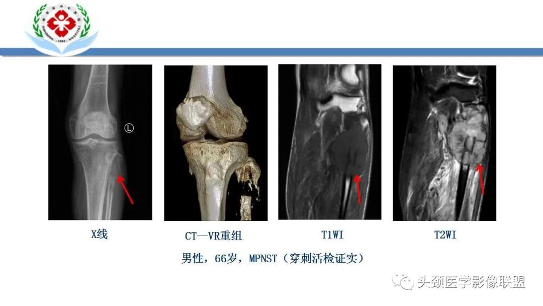 影像PPT - 【PPT】恶性外周神经鞘膜瘤(MPNST)影像学表现与鉴别诊断-15 影像PPT - 【PPT】恶性外周神经鞘膜瘤(MPNST)影像学表现与鉴别诊断-15
