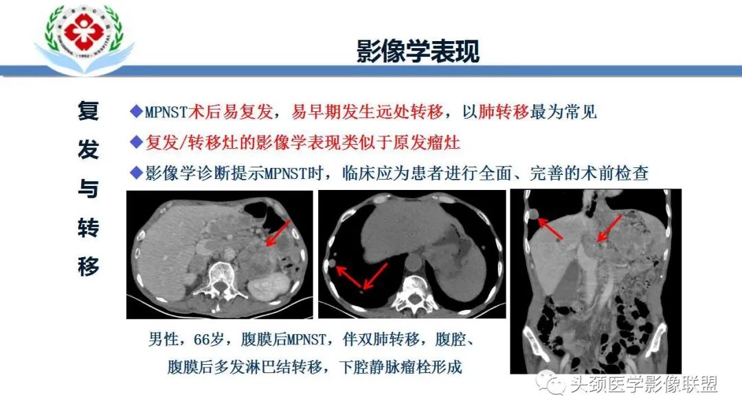影像PPT - 【PPT】恶性外周神经鞘膜瘤(MPNST)影像学表现与鉴别诊断-16 影像PPT - 【PPT】恶性外周神经鞘膜瘤(MPNST)影像学表现与鉴别诊断-16