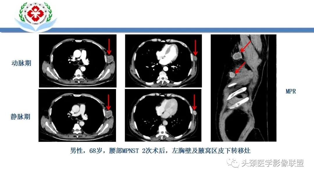 影像PPT - 【PPT】恶性外周神经鞘膜瘤(MPNST)影像学表现与鉴别诊断-17 影像PPT - 【PPT】恶性外周神经鞘膜瘤(MPNST)影像学表现与鉴别诊断-17