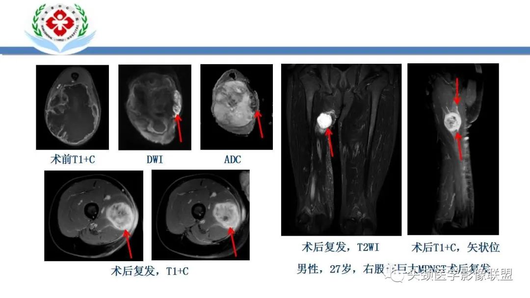 影像PPT - 【PPT】恶性外周神经鞘膜瘤(MPNST)影像学表现与鉴别诊断-18 影像PPT - 【PPT】恶性外周神经鞘膜瘤(MPNST)影像学表现与鉴别诊断-18