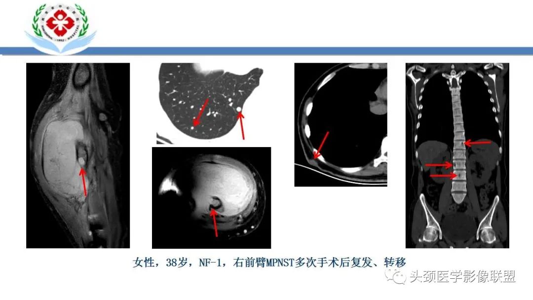 影像PPT - 【PPT】恶性外周神经鞘膜瘤(MPNST)影像学表现与鉴别诊断-19 影像PPT - 【PPT】恶性外周神经鞘膜瘤(MPNST)影像学表现与鉴别诊断-19