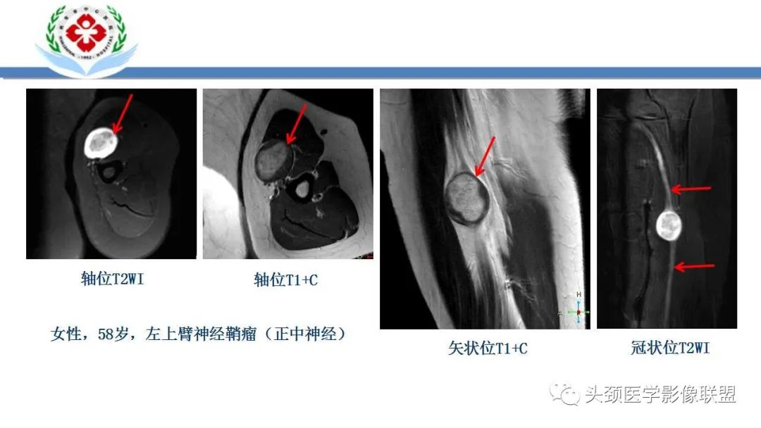 影像PPT - 【PPT】恶性外周神经鞘膜瘤(MPNST)影像学表现与鉴别诊断-22 影像PPT - 【PPT】恶性外周神经鞘膜瘤(MPNST)影像学表现与鉴别诊断-22