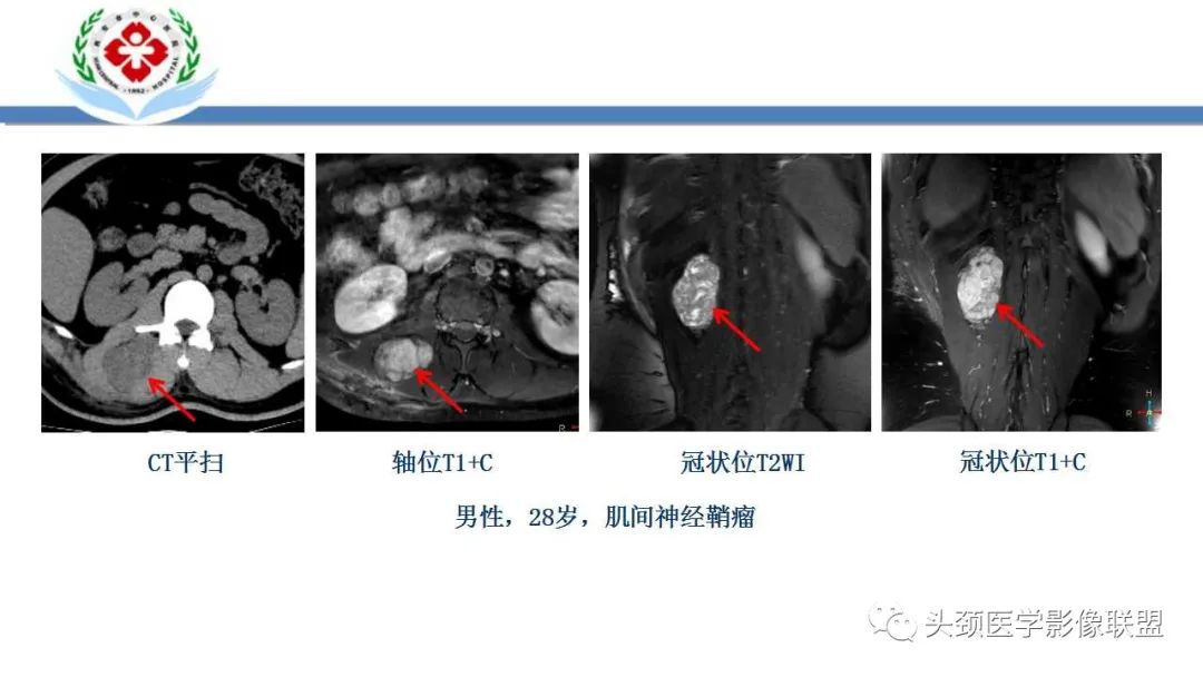 影像PPT - 【PPT】恶性外周神经鞘膜瘤(MPNST)影像学表现与鉴别诊断-23 影像PPT - 【PPT】恶性外周神经鞘膜瘤(MPNST)影像学表现与鉴别诊断-23