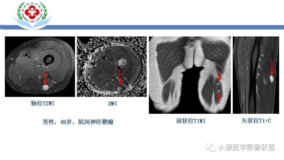 影像PPT - 【PPT】恶性外周神经鞘膜瘤(MPNST)影像学表现与鉴别诊断-24 影像PPT - 【PPT】恶性外周神经鞘膜瘤(MPNST)影像学表现与鉴别诊断-24