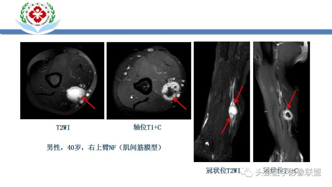 影像PPT - 【PPT】恶性外周神经鞘膜瘤(MPNST)影像学表现与鉴别诊断-27 影像PPT - 【PPT】恶性外周神经鞘膜瘤(MPNST)影像学表现与鉴别诊断-27