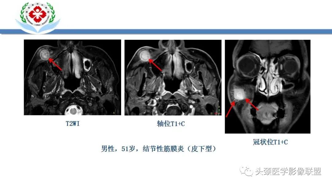 影像PPT - 【PPT】恶性外周神经鞘膜瘤(MPNST)影像学表现与鉴别诊断-26 影像PPT - 【PPT】恶性外周神经鞘膜瘤(MPNST)影像学表现与鉴别诊断-26
