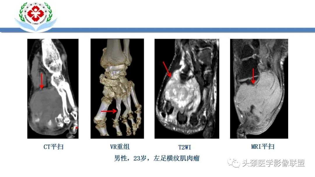 影像PPT - 【PPT】恶性外周神经鞘膜瘤(MPNST)影像学表现与鉴别诊断-29 影像PPT - 【PPT】恶性外周神经鞘膜瘤(MPNST)影像学表现与鉴别诊断-29