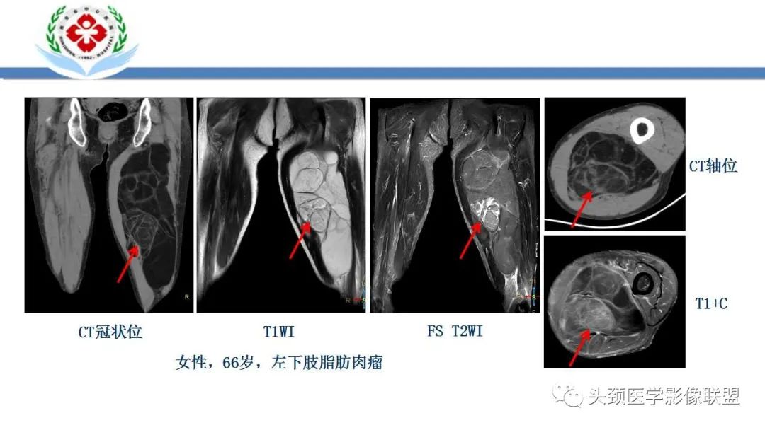影像PPT - 【PPT】恶性外周神经鞘膜瘤(MPNST)影像学表现与鉴别诊断-31 影像PPT - 【PPT】恶性外周神经鞘膜瘤(MPNST)影像学表现与鉴别诊断-31