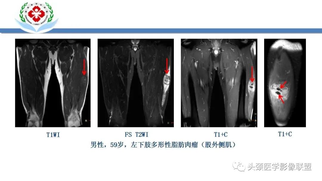影像PPT - 【PPT】恶性外周神经鞘膜瘤(MPNST)影像学表现与鉴别诊断-32 影像PPT - 【PPT】恶性外周神经鞘膜瘤(MPNST)影像学表现与鉴别诊断-32