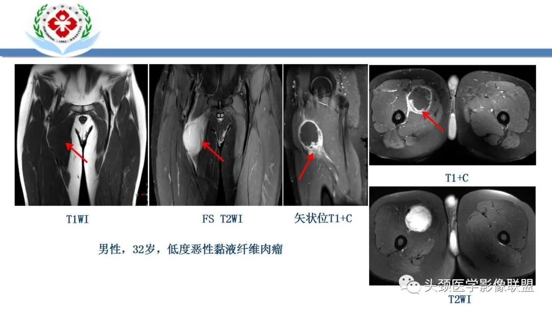 影像PPT - 【PPT】恶性外周神经鞘膜瘤(MPNST)影像学表现与鉴别诊断-35 影像PPT - 【PPT】恶性外周神经鞘膜瘤(MPNST)影像学表现与鉴别诊断-35