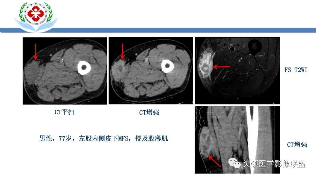 影像PPT - 【PPT】恶性外周神经鞘膜瘤(MPNST)影像学表现与鉴别诊断-36 影像PPT - 【PPT】恶性外周神经鞘膜瘤(MPNST)影像学表现与鉴别诊断-36