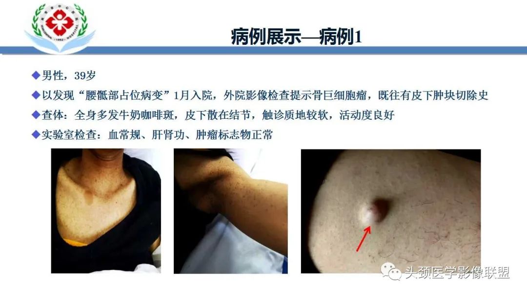 影像PPT - 【PPT】恶性外周神经鞘膜瘤(MPNST)影像学表现与鉴别诊断-37 影像PPT - 【PPT】恶性外周神经鞘膜瘤(MPNST)影像学表现与鉴别诊断-37