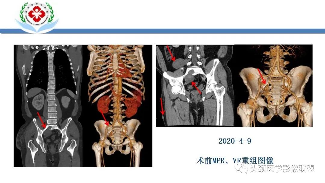 影像PPT - 【PPT】恶性外周神经鞘膜瘤(MPNST)影像学表现与鉴别诊断-39 影像PPT - 【PPT】恶性外周神经鞘膜瘤(MPNST)影像学表现与鉴别诊断-39