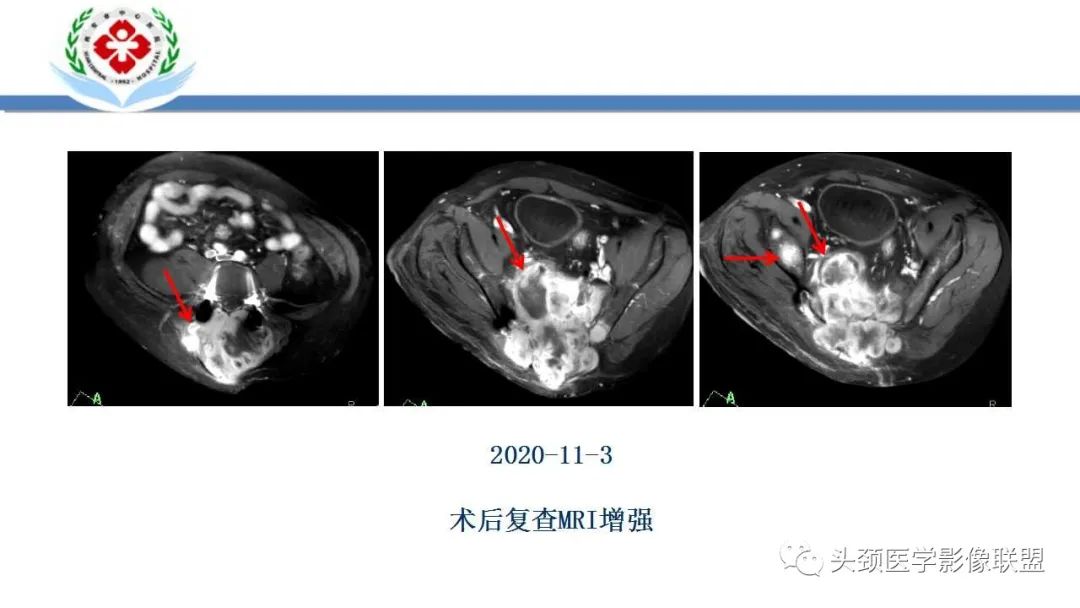 影像PPT - 【PPT】恶性外周神经鞘膜瘤(MPNST)影像学表现与鉴别诊断-44 影像PPT - 【PPT】恶性外周神经鞘膜瘤(MPNST)影像学表现与鉴别诊断-44