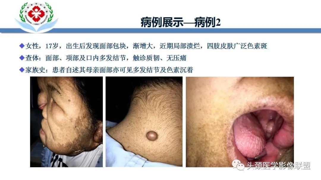 影像PPT - 【PPT】恶性外周神经鞘膜瘤(MPNST)影像学表现与鉴别诊断-49 影像PPT - 【PPT】恶性外周神经鞘膜瘤(MPNST)影像学表现与鉴别诊断-49