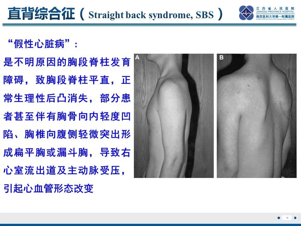影像PPT - 【PPT】直背综合征-14