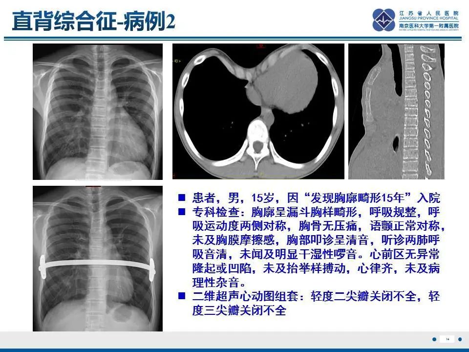 影像PPT - 【PPT】直背综合征-15