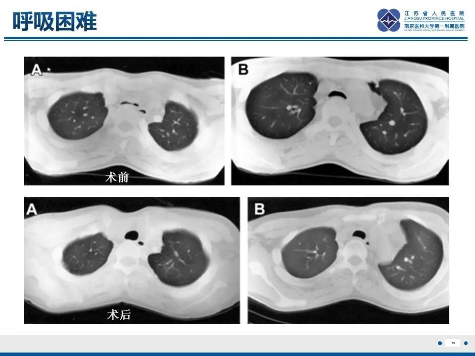 影像PPT - 【PPT】直背综合征-20