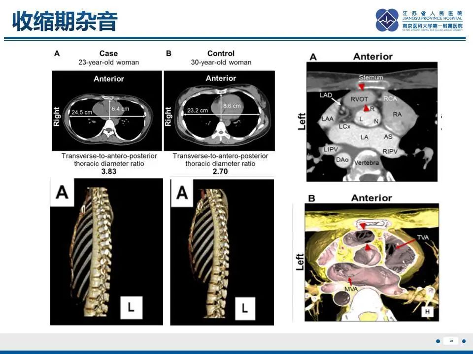 影像PPT - 【PPT】直背综合征-21