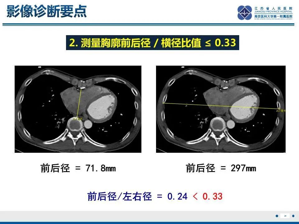 影像PPT - 【PPT】直背综合征-25