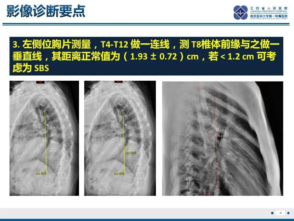 影像PPT - 【PPT】直背综合征-26