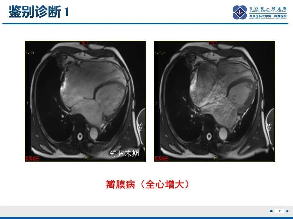 影像PPT - 【PPT】直背综合征-28