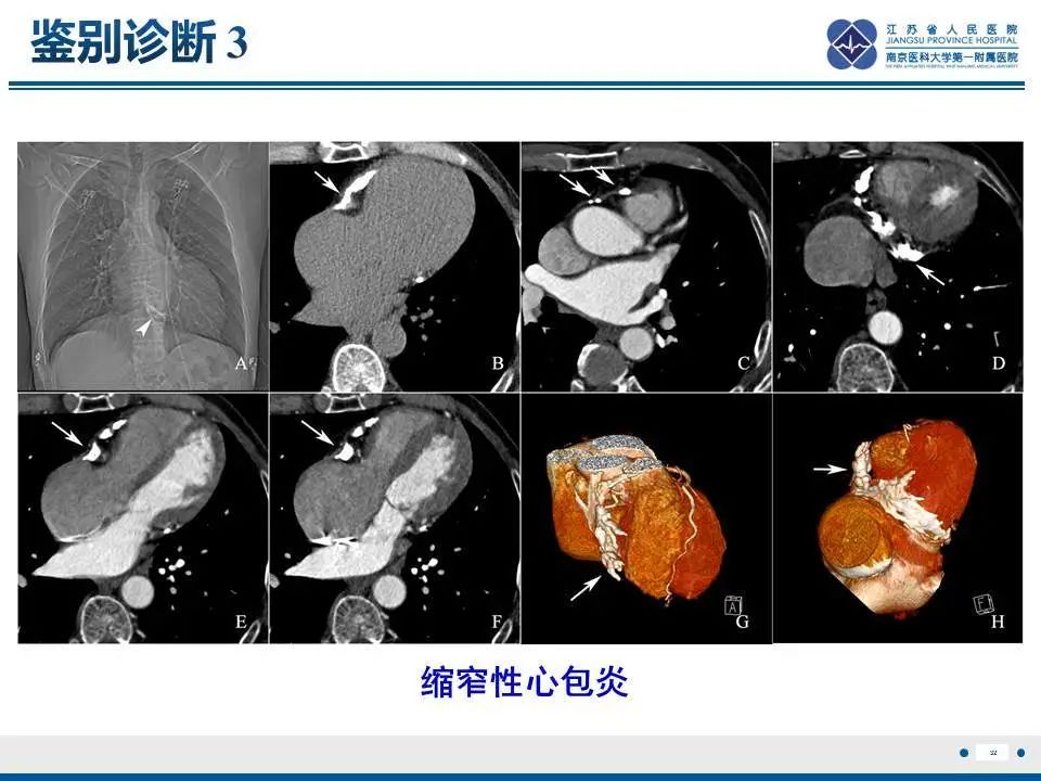 影像PPT - 【PPT】直背综合征-33