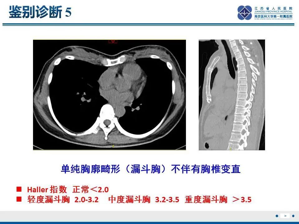 影像PPT - 【PPT】直背综合征-35
