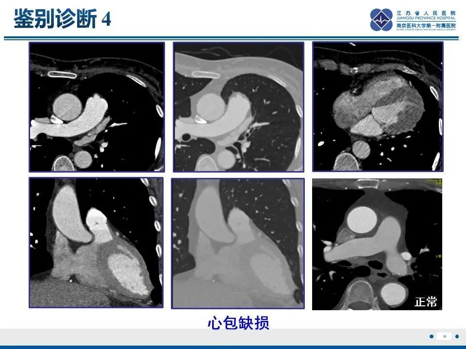 影像PPT - 【PPT】直背综合征-34