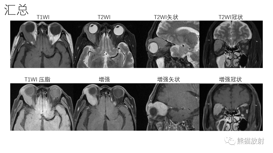 影像PPT - 【PPT】泪腺多形性腺瘤 VS 眼眶淋巴瘤-8