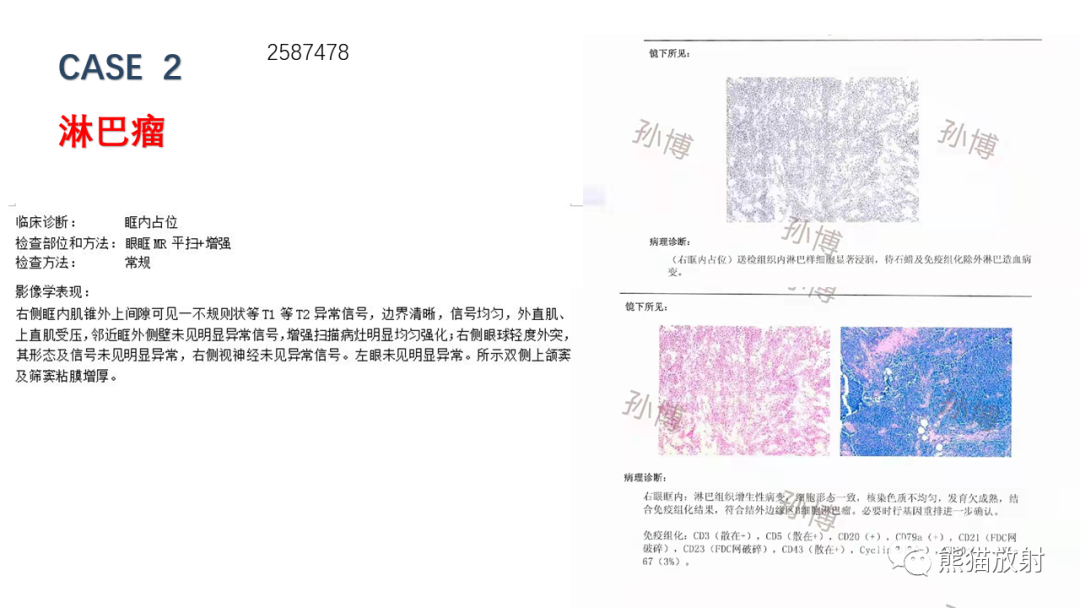 影像PPT - 【PPT】泪腺多形性腺瘤 VS 眼眶淋巴瘤-13