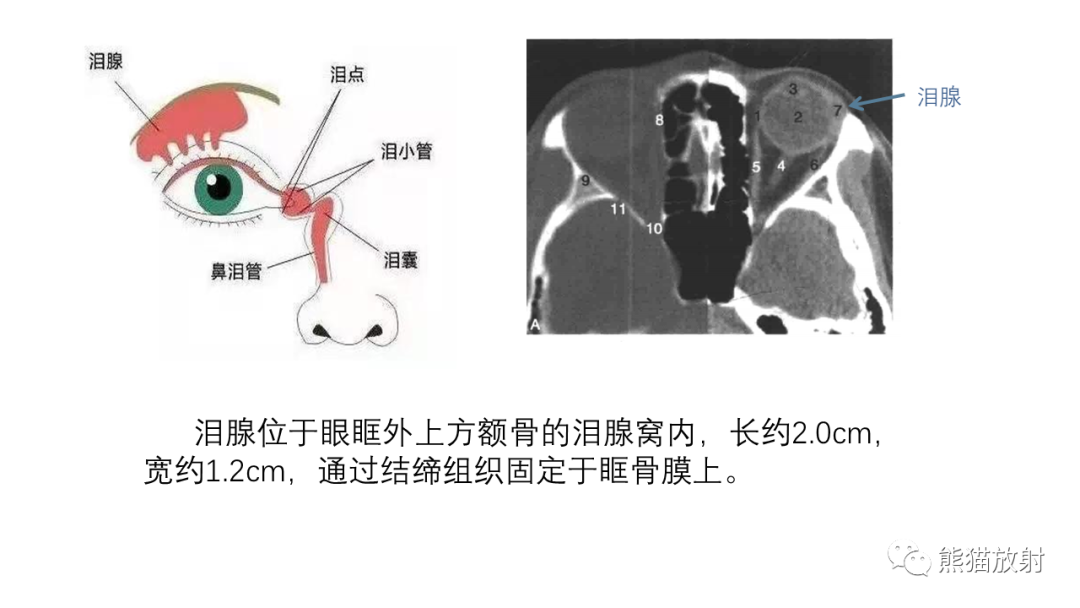 影像PPT - 【PPT】泪腺多形性腺瘤 VS 眼眶淋巴瘤-15