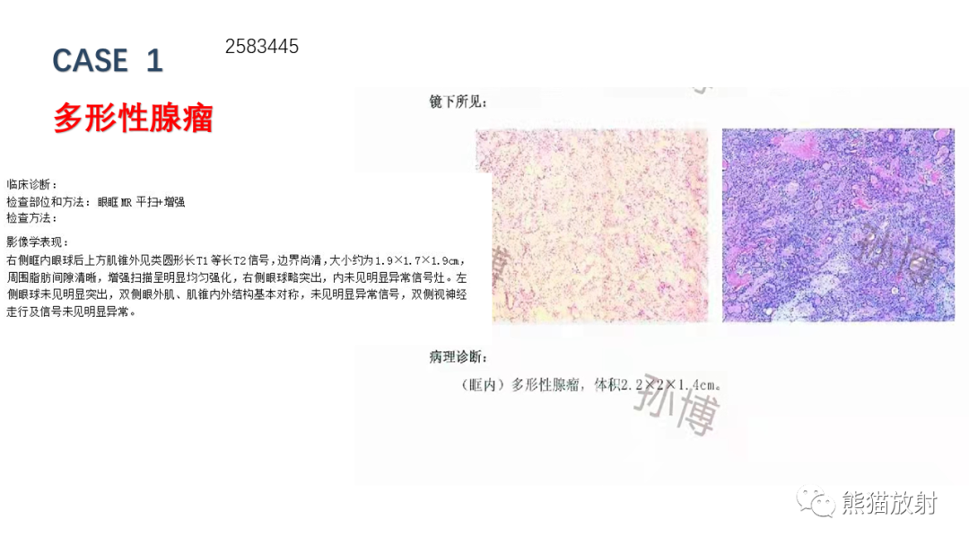 影像PPT - 【PPT】泪腺多形性腺瘤 VS 眼眶淋巴瘤-12