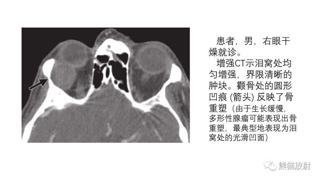 影像PPT - 【PPT】泪腺多形性腺瘤 VS 眼眶淋巴瘤-21