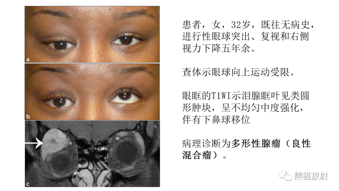 影像PPT - 【PPT】泪腺多形性腺瘤 VS 眼眶淋巴瘤-22