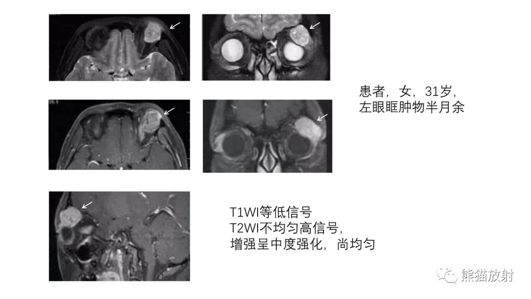 影像PPT - 【PPT】泪腺多形性腺瘤 VS 眼眶淋巴瘤-23