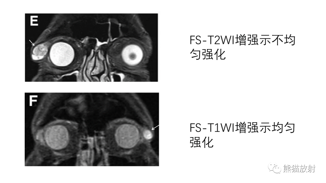 影像PPT - 【PPT】泪腺多形性腺瘤 VS 眼眶淋巴瘤-24