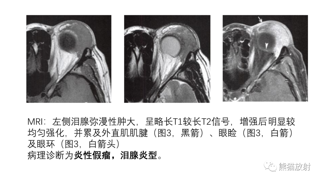影像PPT - 【PPT】泪腺多形性腺瘤 VS 眼眶淋巴瘤-28