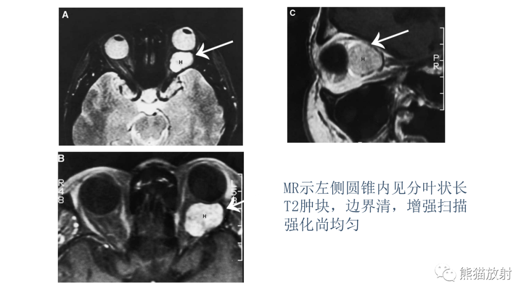 影像PPT - 【PPT】泪腺多形性腺瘤 VS 眼眶淋巴瘤-30