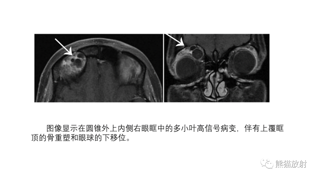 影像PPT - 【PPT】泪腺多形性腺瘤 VS 眼眶淋巴瘤-33
