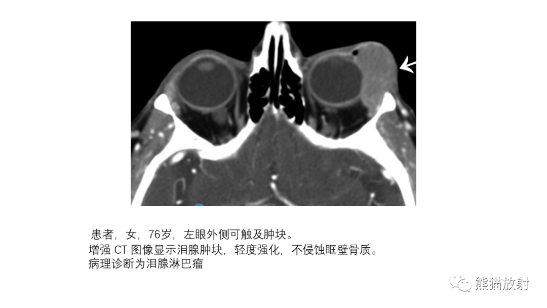 影像PPT - 【PPT】泪腺多形性腺瘤 VS 眼眶淋巴瘤-35