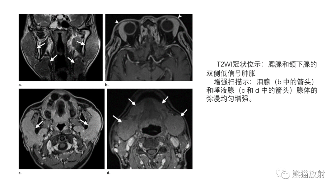 影像PPT - 【PPT】泪腺多形性腺瘤 VS 眼眶淋巴瘤-37