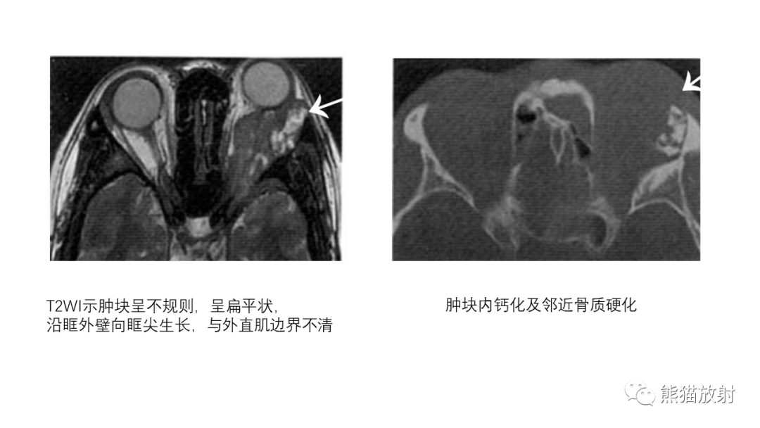 影像PPT - 【PPT】泪腺多形性腺瘤 VS 眼眶淋巴瘤-39