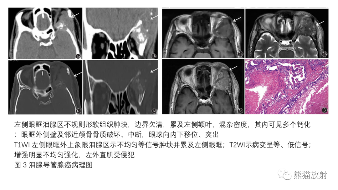 影像PPT - 【PPT】泪腺多形性腺瘤 VS 眼眶淋巴瘤-41