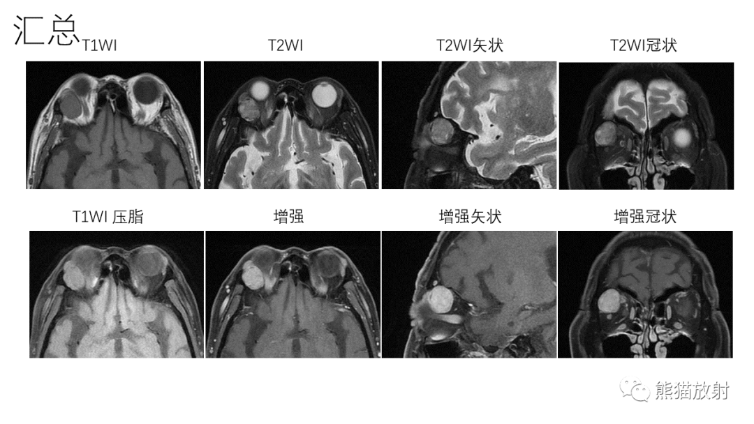 影像PPT - 【PPT】泪腺多形性腺瘤 VS 眼眶淋巴瘤-2