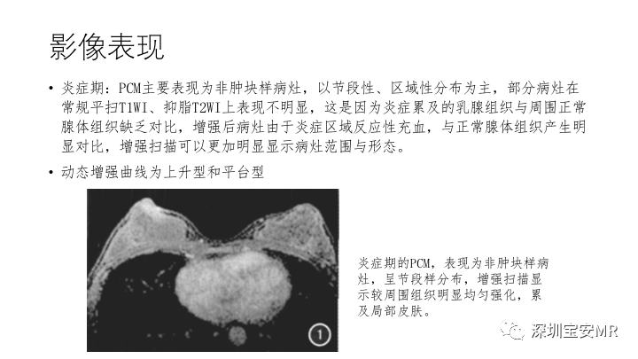 影像PPT - 【PPT】浆细胞性乳腺炎的MRI诊断-4