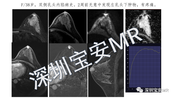 影像PPT - 【PPT】浆细胞性乳腺炎的MRI诊断-5