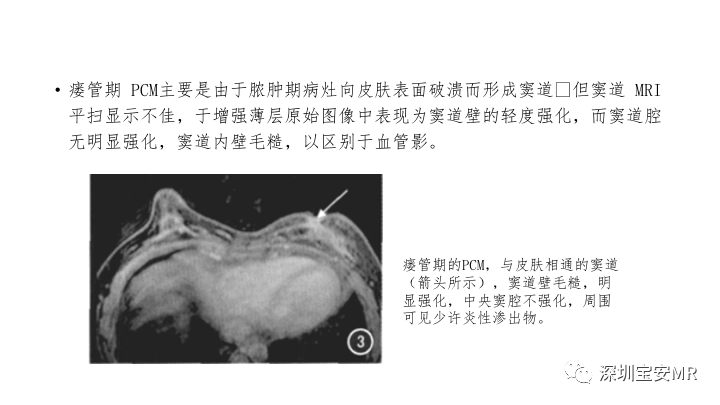 影像PPT - 【PPT】浆细胞性乳腺炎的MRI诊断-10