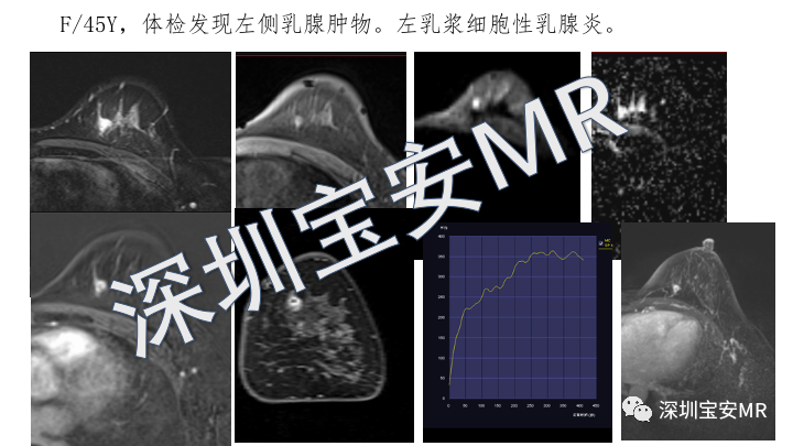 影像PPT - 【PPT】浆细胞性乳腺炎的MRI诊断-8