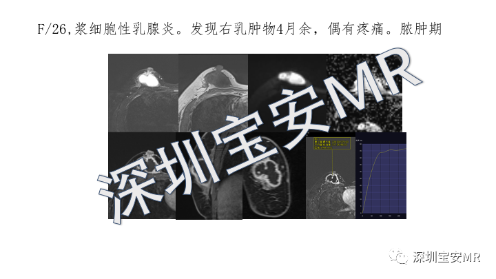 影像PPT - 【PPT】浆细胞性乳腺炎的MRI诊断-7